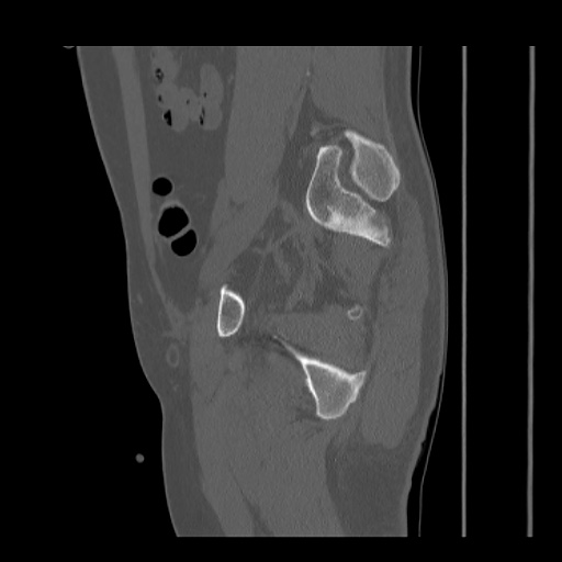 Acetabular and ilial fractures (Radiopaedia 59084-66378 Sagittal bone window 66).jpg
