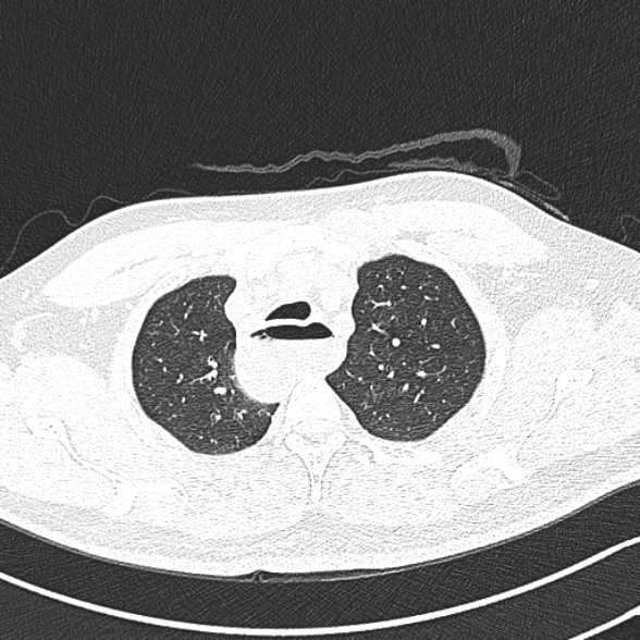 Achalasia with aspiration (Radiopaedia 55413-61845 Axial lung window 13).jpg