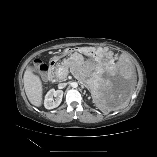 Acinar cell carcinoma of the pancreas (Radiopaedia 75442-86669 Axial C+ portal venous phase 52).jpg