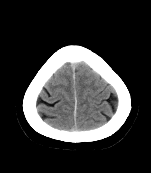 File:Acoustic schwannoma (Radiopaedia 33045-34065 Axial non-contrast 25).png