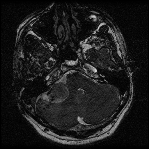File:Acoustic schwannoma (Radiopaedia 39170-41387 Axial FIESTA 56).png