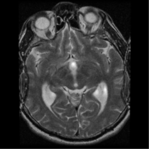 File:Acoustic schwannoma (Radiopaedia 39170-41387 Axial T2 17).png