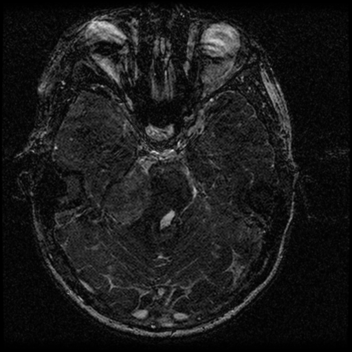 Acoustic schwannoma - eroding petrous apex (Radiopaedia 39674-42004 Axial T2 67).png