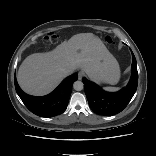 File:Active colonic bleed on CT (Radiopaedia 49765-55025 Axial C+ delayed 13).jpg