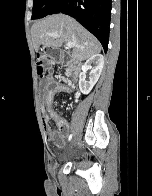 Active crohn disease (Radiopaedia 87133-103397 Sagittal C+ arterial phase 29).jpg