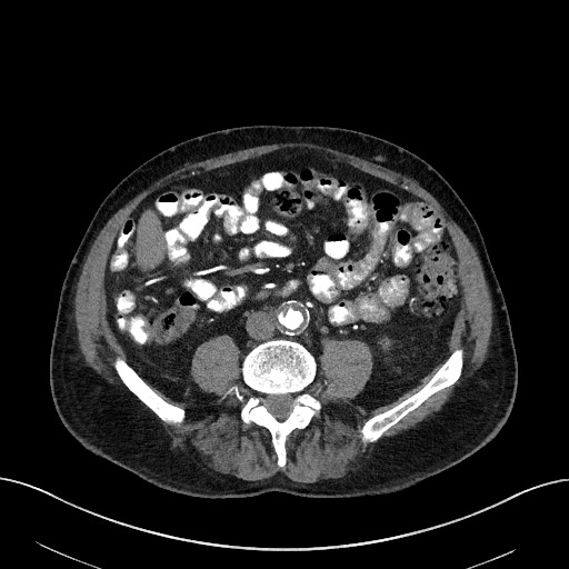 Active lower gastrointestinal bleeding - diverticular (Radiopaedia 61203-69106 Axial C+ arterial phase 5).jpg
