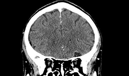 File:Active neurocysticercosis before and after therapy (Radiopaedia 71710-82099 Coronal C+ delayed 26).jpg