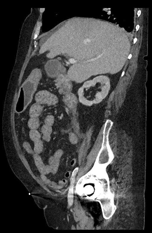 Active renal extravasation with large subcapsular and retroperitoneal hemorrhage (Radiopaedia 60975-68796 Sagittal C+ portal venous phase 149).jpg