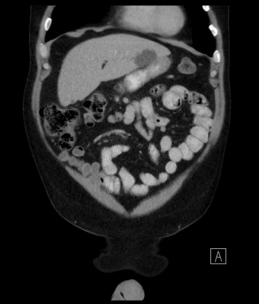 Acute-on-chronic pancreatitis (Radiopaedia 67286-76656 Coronal C+ portal venous phase 24).jpg
