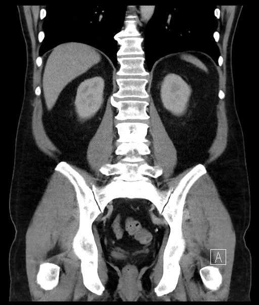 Acute-on-chronic pancreatitis (Radiopaedia 67286-76656 Coronal C+ portal venous phase 53).jpg