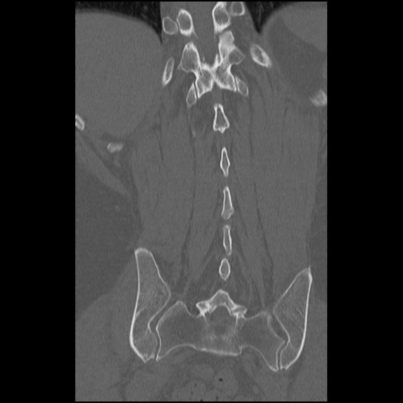 Acute Schmorl's node (Radiopaedia 83276-102365 Coronal bone window 45).jpg