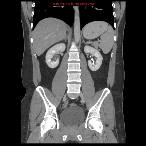File:Acute appendicitis (Radiopaedia 10498-10973 F 28).jpg