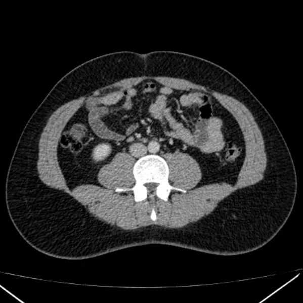 Acute appendicitis (Radiopaedia 38255-40270 Axial C+ portal venous phase 59).jpg