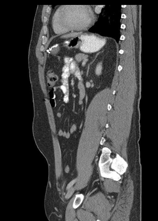 Acute appendicitis (Radiopaedia 48511-53463 Sagittal C+ portal venous phase 86).jpg