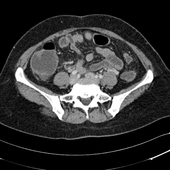 File:Acute appendicitis (Radiopaedia 48792-53822 Axial C+ portal venous phase 78).jpg