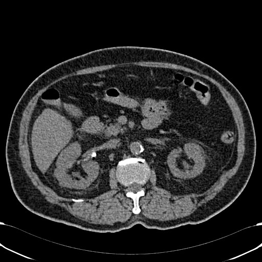 File:Acute appendicitis (Radiopaedia 58627-65818 Axial non-contrast 35).jpg