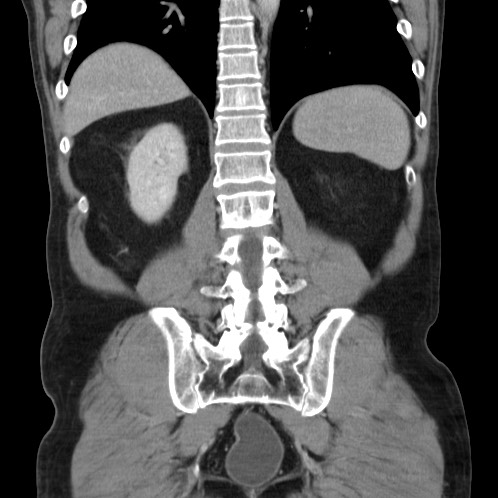 Acute appendicitis (Radiopaedia 66513-75790 Coronal C+ portal venous phase 67).jpg