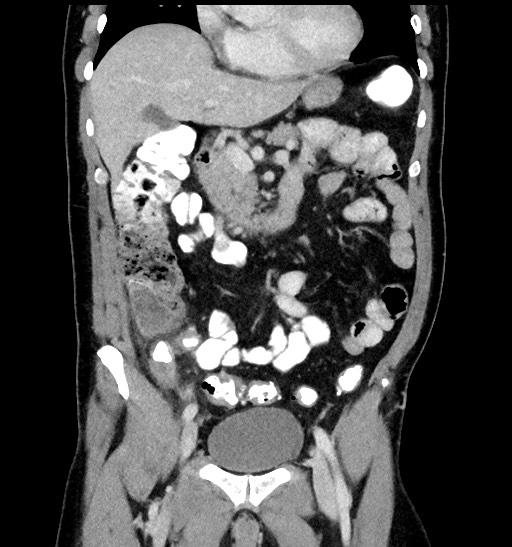 Acute appendicitis (Radiopaedia 77016-88960 Coronal C+ portal venous phase 43).jpg