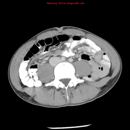 Acute appendicitis (Radiopaedia 8195-9045 Axial C+ portal venous phase 44).jpg