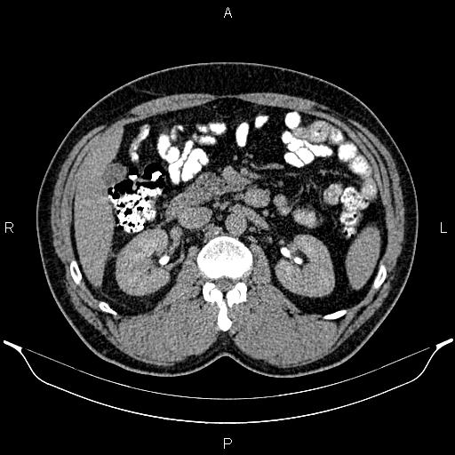 File:Acute appendicitis (Radiopaedia 84780-100240 Axial C+ delayed 41).jpg