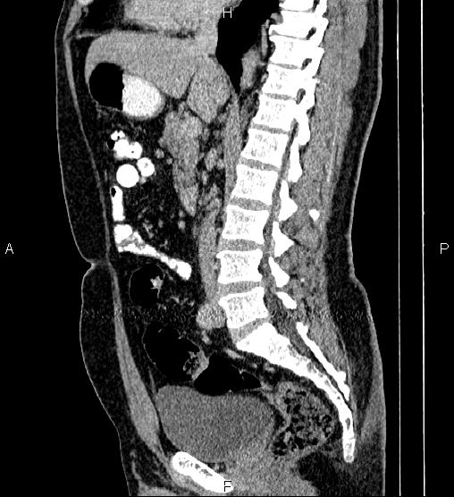 Acute appendicitis (Radiopaedia 84780-100240 Sagittal C+ portal venous phase 50).jpg