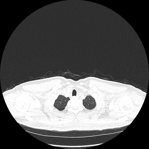 Acute appendicitis and COVID 19 pneumonia (Radiopaedia 76604-88380 Axial lung window 7).jpg