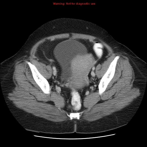 File:Acute appendicitis complicated by ovarian vein thrombophlebitis (Radiopaedia 16172-15851 Axial C+ portal venous phase 76).jpg