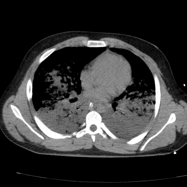 Acute aspiration pneumonitis (Radiopaedia 33605-34703 Axial non-contrast 50).jpg