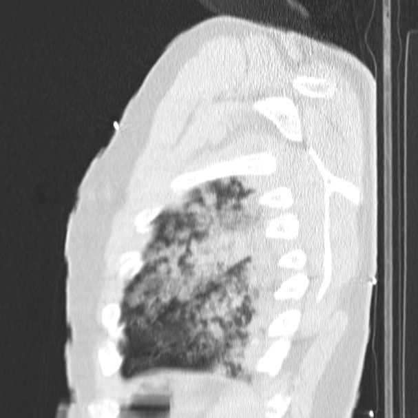 Acute aspiration pneumonitis (Radiopaedia 33605-34703 Sagittal lung window 76).jpg