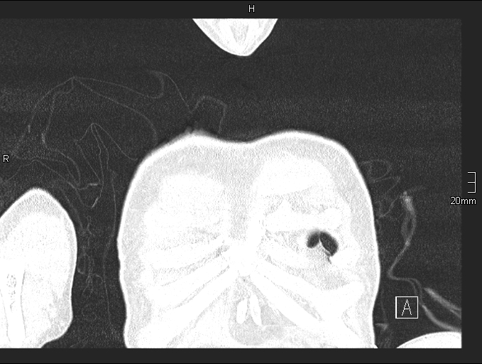 Acute aspiration pneumonitis (Radiopaedia 55642-62166 Coronal lung window 4).jpg
