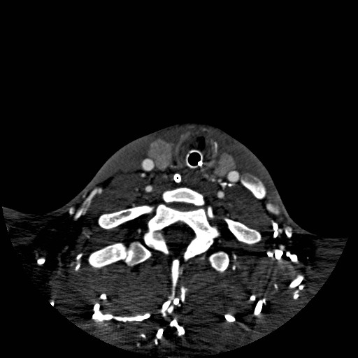 Acute basilar artery occlusion (Radiopaedia 43582-46985 Axial C+ arterial phase 260).jpg