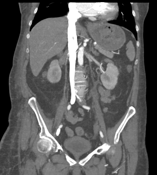File:Acute bleed from gastric fundus biopsy site (Radiopaedia 35201-36737 Coronal C+ arterial phase 30).png