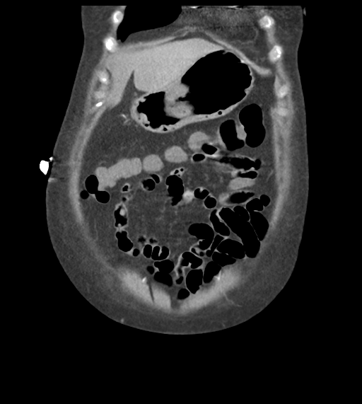 File:Acute bleed from gastric fundus biopsy site (Radiopaedia 35201-36737 D 14).png