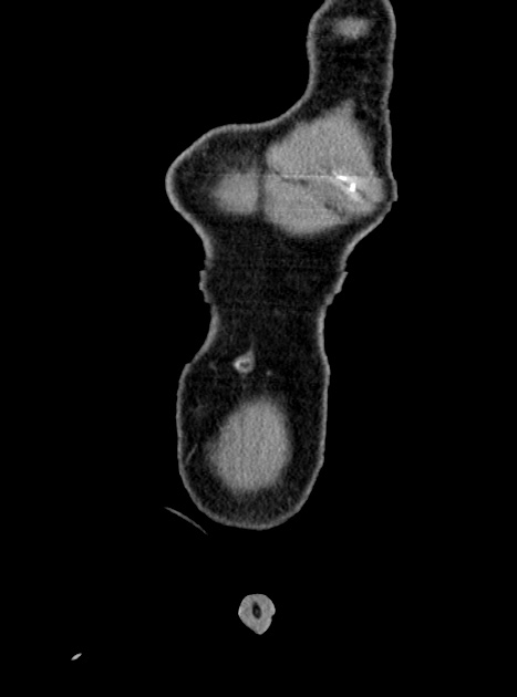 Acute bowel ischemia (Radiopaedia 87695-104114 Coronal C+ portal venous phase 60).jpg
