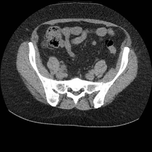 File:Acute cholecystitis and ureteric colic (Radiopaedia 42330-45444 Axial prone 79).jpg