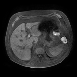 Acute cholecystitis complicated by pylephlebitis (Radiopaedia 65782-74915 Axial T1 fat sat 31).jpg
