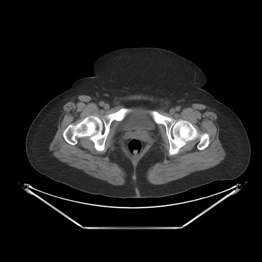 Acute cholecystitis with tensile fundus sign (Radiopaedia 71394-81723 Axial non-contrast 116).jpg
