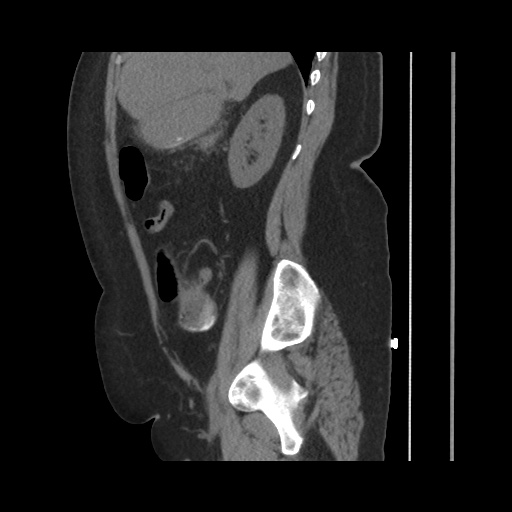 Acute cholecystitis with tensile fundus sign (Radiopaedia 71394-81723 Sagittal non-contrast 64).jpg