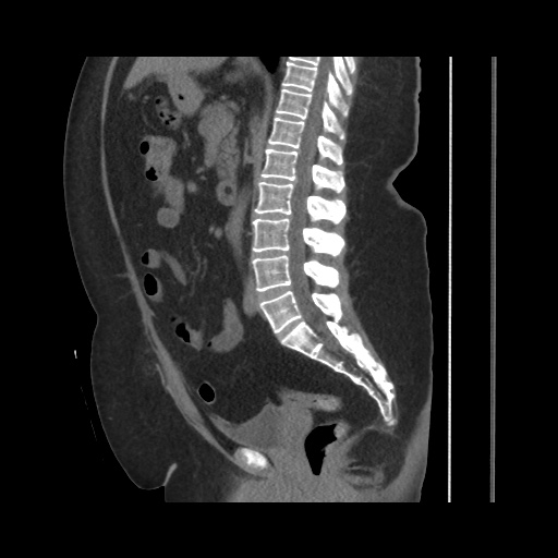 Acute cholecystitis with tensile fundus sign (Radiopaedia 71394-81723 Sagittal non-contrast 89).jpg