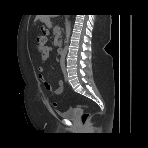 Acute cholecystitis with tensile fundus sign (Radiopaedia 71394-81723 Sagittal non-contrast 91).jpg