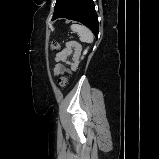 Acute diverticulitis - transverse colon (Radiopaedia 87063-103327 Sagittal C+ portal venous phase 173).jpg