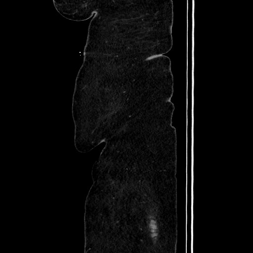 Acute diverticulitis - transverse colon (Radiopaedia 87063-103327 Sagittal C+ portal venous phase 36).jpg