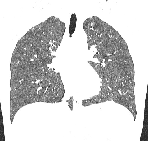 Acute hypersensitivity pneumonitis (Radiopaedia 85293-100870 Coronal lung window 62).jpg