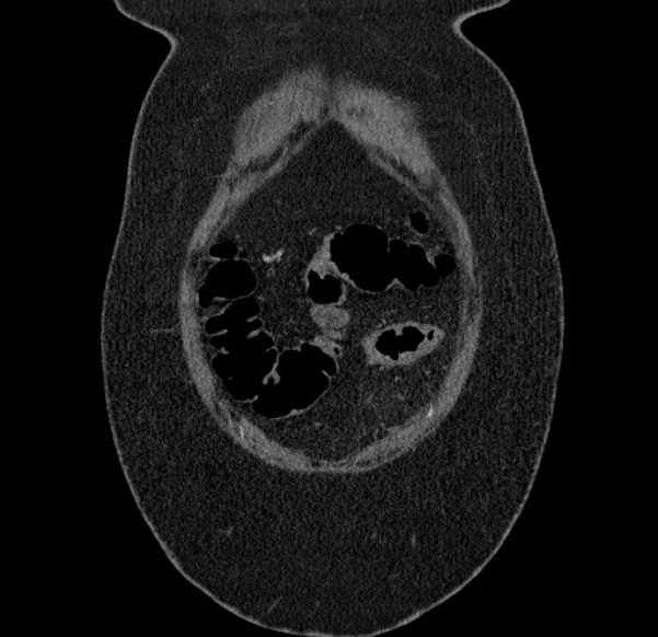Acute mesenteric ischemia (Radiopaedia 80029-93316 Coronal C+ arterial phase 7).jpg