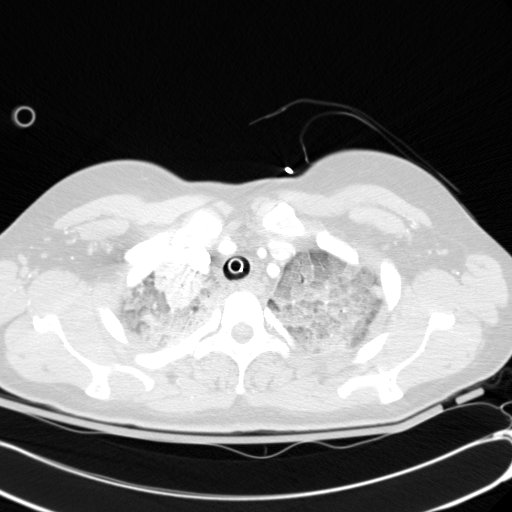File:Acute myocardial infarction in CT (Radiopaedia 39947-42415 Axial lung window 17).jpg