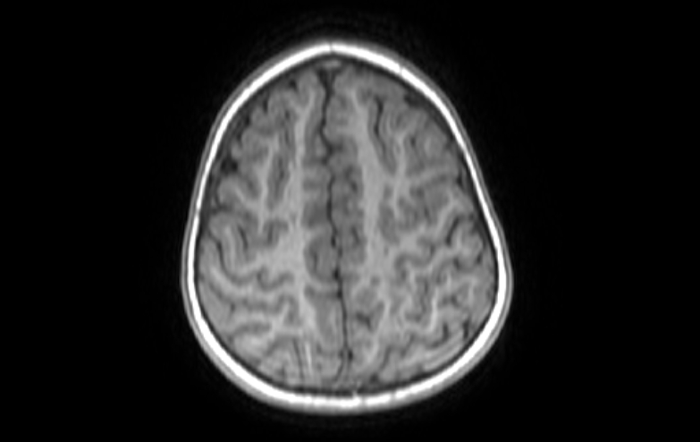 File:Acute necrotizing encephalitis of childhood (Radiopaedia 67356-76737 Axial T1 18).jpg