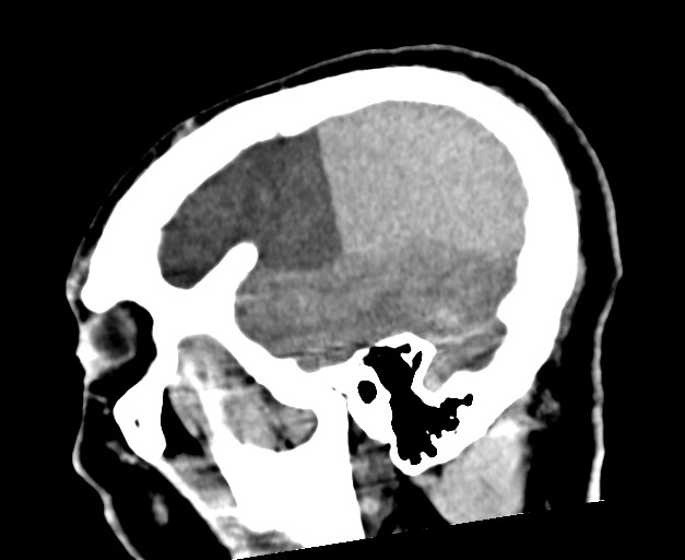 Acute on chronic subdural hematoma (Radiopaedia 78346-90966 Sagittal non-contrast 46).jpg