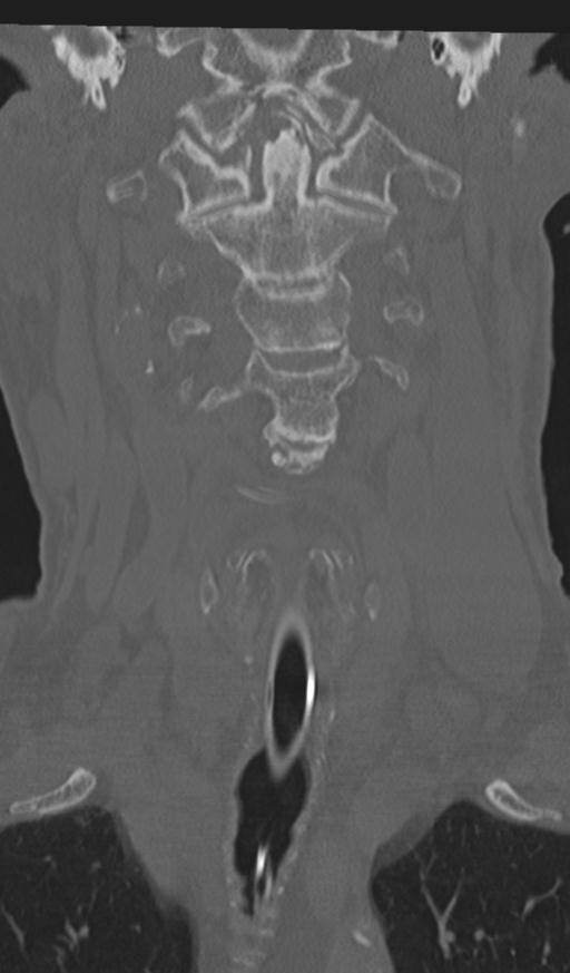 Acute on chronic subdural hematoma and thoracic vertebral injury in a multitrauma patient (Radiopaedia 31698-32619 Coronal bone window 15).jpg