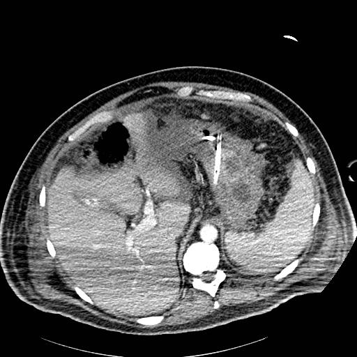 Acute pancreatic necrosis (Radiopaedia 13560-18502 Axial C+ portal venous phase 7).jpg