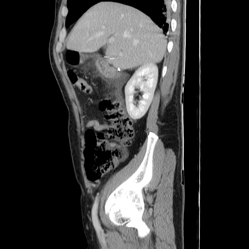 Acute pancreatitis (Radiopaedia 22572-22596 Sagittal C+ portal venous phase 15).jpg